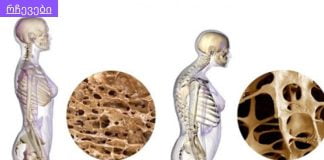 მიიღეთ სამედიცინო განმარტებები,ყველამ უნდა იცოდეს.კავშირი ოსტეოპოროზსა და თირკმლის მიკროფლორას შორის.