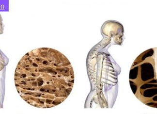 მიიღეთ სამედიცინო განმარტებები,ყველამ უნდა იცოდეს.კავშირი ოსტეოპოროზსა და თირკმლის მიკროფლორას შორის.