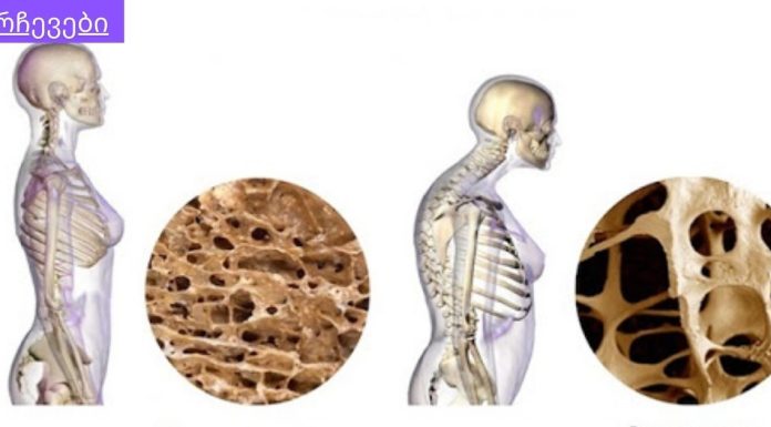 მიიღეთ სამედიცინო განმარტებები,ყველამ უნდა იცოდეს.კავშირი ოსტეოპოროზსა და თირკმლის მიკროფლორას შორის.
