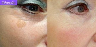 სასწაული შედეგი მაქვს.ჩაი მუქი ლაქებისთვის.