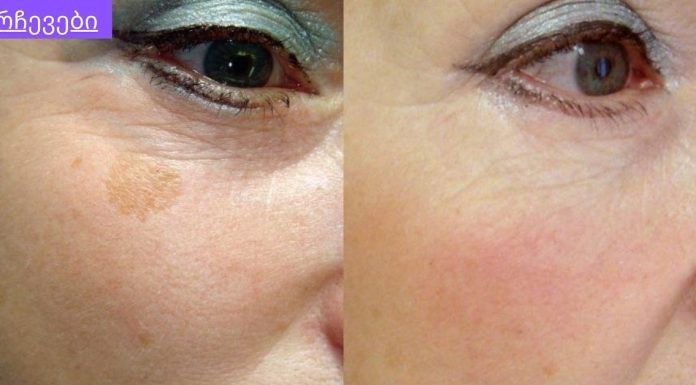 სასწაული შედეგი მაქვს.ჩაი მუქი ლაქებისთვის.