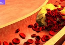 მაღალი ქოლესტერინი და მაღალი წნევა ძალიან საშიში და ძალიან გავრცელებული პრობლემაა.ქოლესტერინისა და ჰიპერტენზიის წინააღმდეგ ბრძოლის 8 გზა