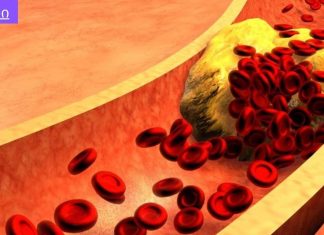 მაღალი ქოლესტერინი და მაღალი წნევა ძალიან საშიში და ძალიან გავრცელებული პრობლემაა.ქოლესტერინისა და ჰიპერტენზიის წინააღმდეგ ბრძოლის 8 გზა