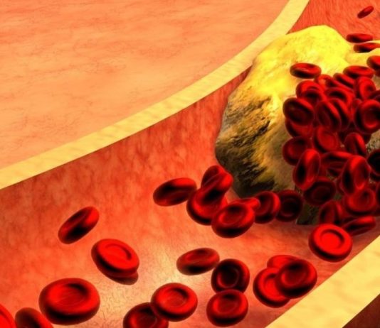 მაღალი ქოლესტერინი და მაღალი წნევა ძალიან საშიში და ძალიან გავრცელებული პრობლემაა.ქოლესტერინისა და ჰიპერტენზიის წინააღმდეგ ბრძოლის 8 გზა