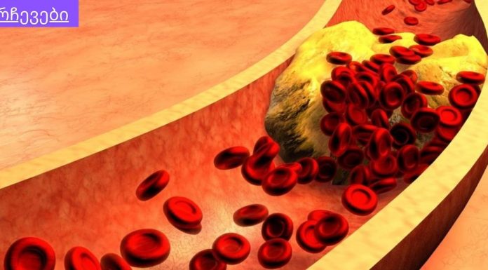 მაღალი ქოლესტერინი და მაღალი წნევა ძალიან საშიში და ძალიან გავრცელებული პრობლემაა.ქოლესტერინისა და ჰიპერტენზიის წინააღმდეგ ბრძოლის 8 გზა