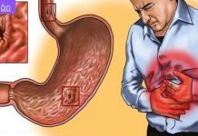 რა სამწუხაროა, რომ ამდენი ხანი ვიტანჯე ტკივილებით და ადრე არ ვისწავლე ამ მეთოდების შესახებ!ხალხური საშუალებები გასტრიტის სამკურნალოდ