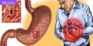 რა სამწუხაროა, რომ ამდენი ხანი ვიტანჯე ტკივილებით და ადრე არ ვისწავლე ამ მეთოდების შესახებ!ხალხური საშუალებები გასტრიტის სამკურნალოდ