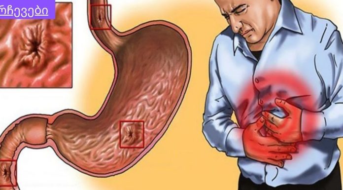 რა სამწუხაროა, რომ ამდენი ხანი ვიტანჯე ტკივილებით და ადრე არ ვისწავლე ამ მეთოდების შესახებ!ხალხური საშუალებები გასტრიტის სამკურნალოდ