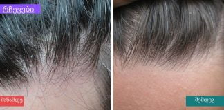 ძმრის ნარევი ქერტლის სწრაფად სამკურნალოდ