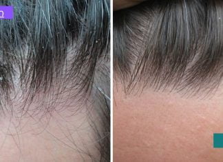 ძმრის ნარევი ქერტლის სწრაფად სამკურნალოდ