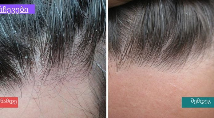 ძმრის ნარევი ქერტლის სწრაფად სამკურნალოდ