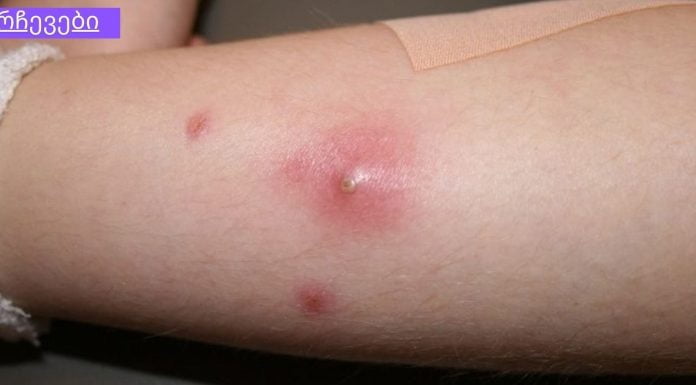 ფურუნკული(ძირმაგარა) და მათი მკურნალობის უამრავი რეცეპტი