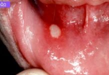 სტომატიტი – მკურნალობა ხალხური საშუალებებით