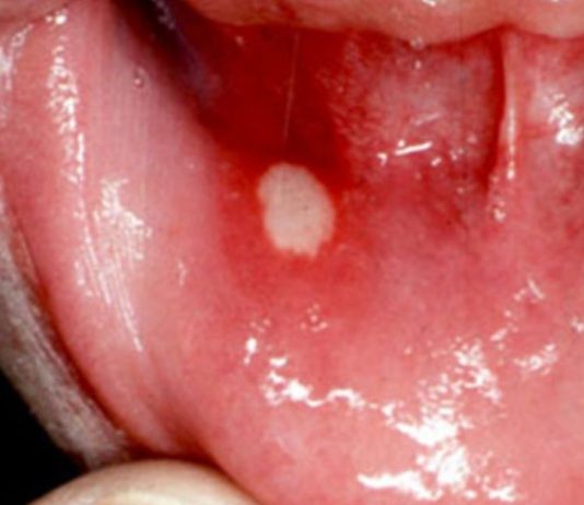 სტომატიტი – მკურნალობა ხალხური საშუალებებით