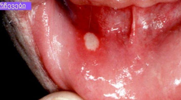 სტომატიტი – მკურნალობა ხალხური საშუალებებით