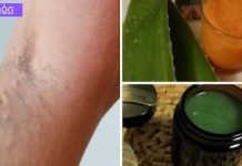 ეს ძველი ხალხური რეცეპტი შეამცირებს ვარიკოზული ვენების სიმპტომებს