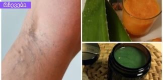 ეს ძველი ხალხური რეცეპტი შეამცირებს ვარიკოზული ვენების სიმპტომებს