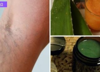 ეს ძველი ხალხური რეცეპტი შეამცირებს ვარიკოზული ვენების სიმპტომებს