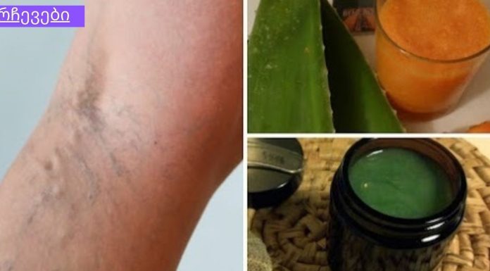 ეს ძველი ხალხური რეცეპტი შეამცირებს ვარიკოზული ვენების სიმპტომებს