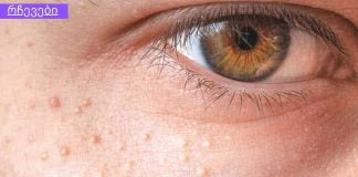 ეს თითქმის ყველა ადამიანს აწუხებს ,როგორ მოვიშოროთ რძის ლაქა სახეზე? ბუნებრივი საშუალება