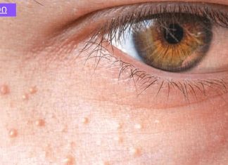 ეს თითქმის ყველა ადამიანს აწუხებს ,როგორ მოვიშოროთ რძის ლაქა სახეზე? ბუნებრივი საშუალება