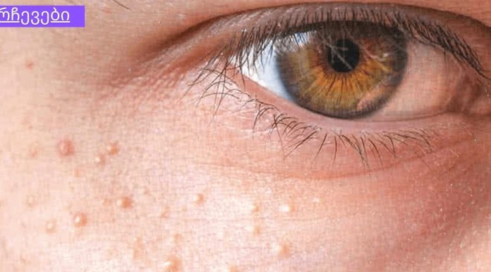 ეს თითქმის ყველა ადამიანს აწუხებს ,როგორ მოვიშოროთ რძის ლაქა სახეზე? ბუნებრივი საშუალება