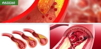 აი რატომ არ უნდა მიირთვათ მაღალი ცხიმოვანი საკვები,ათეროსკლეროზი და თრომბოციტები