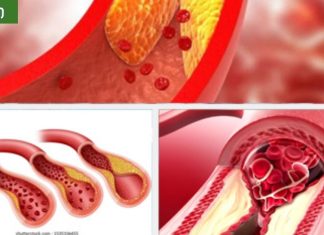 აი რატომ არ უნდა მიირთვათ მაღალი ცხიმოვანი საკვები,ათეროსკლეროზი და თრომბოციტები