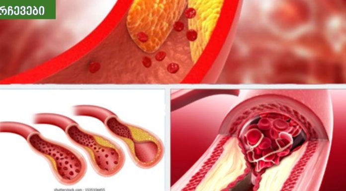 აი რატომ არ უნდა მიირთვათ მაღალი ცხიმოვანი საკვები,ათეროსკლეროზი და თრომბოციტები