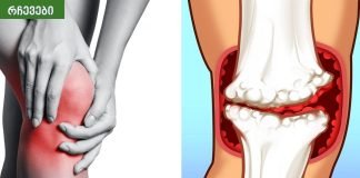 საკვები, რომელიც უნდა მოიცილოთ ართრიტის დროს, რადგან ისინი საზიანოა სახსრებისთვის