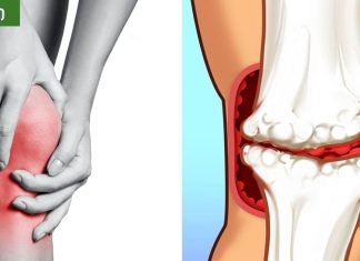 საკვები, რომელიც უნდა მოიცილოთ ართრიტის დროს, რადგან ისინი საზიანოა სახსრებისთვის