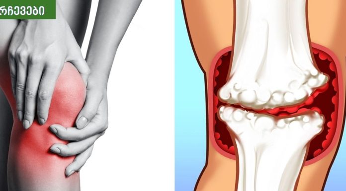 საკვები, რომელიც უნდა მოიცილოთ ართრიტის დროს, რადგან ისინი საზიანოა სახსრებისთვის