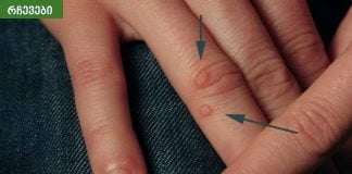 5 საშინაო საშუალება მეჭეჭების მოსაშორებლად.