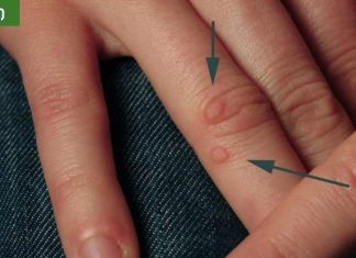 5 საშინაო საშუალება მეჭეჭების მოსაშორებლად.