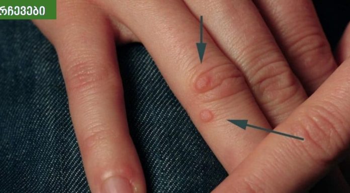 5 საშინაო საშუალება მეჭეჭების მოსაშორებლად.