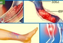 თრომბოზის 5 მიზეზი და სპეციალური ვარჯიშები