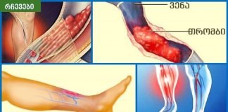 თრომბოზის 5 მიზეზი და სპეციალური ვარჯიშები