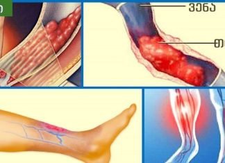 თრომბოზის 5 მიზეზი და სპეციალური ვარჯიშები