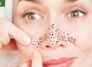 შავი წერტილების მოშორების უმარტივესი მეთოდები ყველა ასაკისთვის.