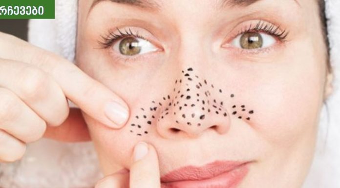 შავი წერტილების მოშორების უმარტივესი მეთოდები ყველა ასაკისთვის.