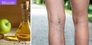 ვარიკოზული ვენების მკურნალობა სახლში