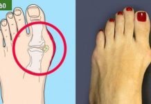 საშინაო საშუალებები პოდაგრის პროფილაქტიკისთვის