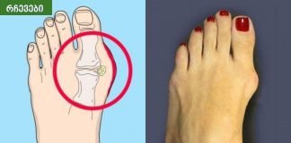 საშინაო საშუალებები პოდაგრის პროფილაქტიკისთვის