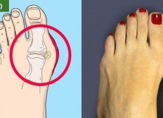 საშინაო საშუალებები პოდაგრის პროფილაქტიკისთვის