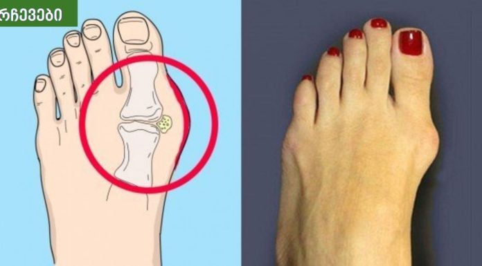 საშინაო საშუალებები პოდაგრის პროფილაქტიკისთვის