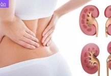 ამ ქალბატონს წელის არეში გავლითი ტკივილები ჰქონდა და მკურნალობდა როგორც წელის ტკივილი,,თირკმლის კენჭები, რა სიმპტომეები აქვს და როგორ უნდა უმკურნალოთ.