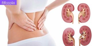 ამ ქალბატონს წელის არეში გავლითი ტკივილები ჰქონდა და მკურნალობდა როგორც წელის ტკივილი,,თირკმლის კენჭები, რა სიმპტომეები აქვს და როგორ უნდა უმკურნალოთ.