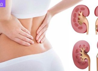 ამ ქალბატონს წელის არეში გავლითი ტკივილები ჰქონდა და მკურნალობდა როგორც წელის ტკივილი,,თირკმლის კენჭები, რა სიმპტომეები აქვს და როგორ უნდა უმკურნალოთ.