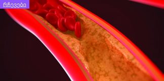 თრომბის “დაცობა” სწორეედ ამიტომ ხდება,ბევრმა არ იცის თრომბის გამომწვევი ერთ-ერთი მიზეზი,ათეროსკლეროზი,სიმპტომები,დაგნოსტიკა და მკურნალობა.