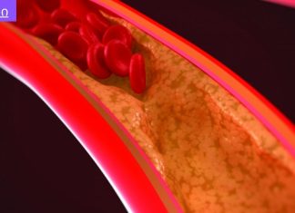 თრომბის “დაცობა” სწორეედ ამიტომ ხდება,ბევრმა არ იცის თრომბის გამომწვევი ერთ-ერთი მიზეზი,ათეროსკლეროზი,სიმპტომები,დაგნოსტიკა და მკურნალობა.